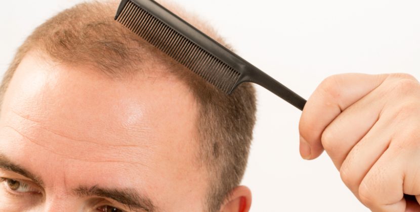 The Benefits of Getting a Hair Graft Procedure