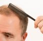 The Benefits of Getting a Hair Graft Procedure